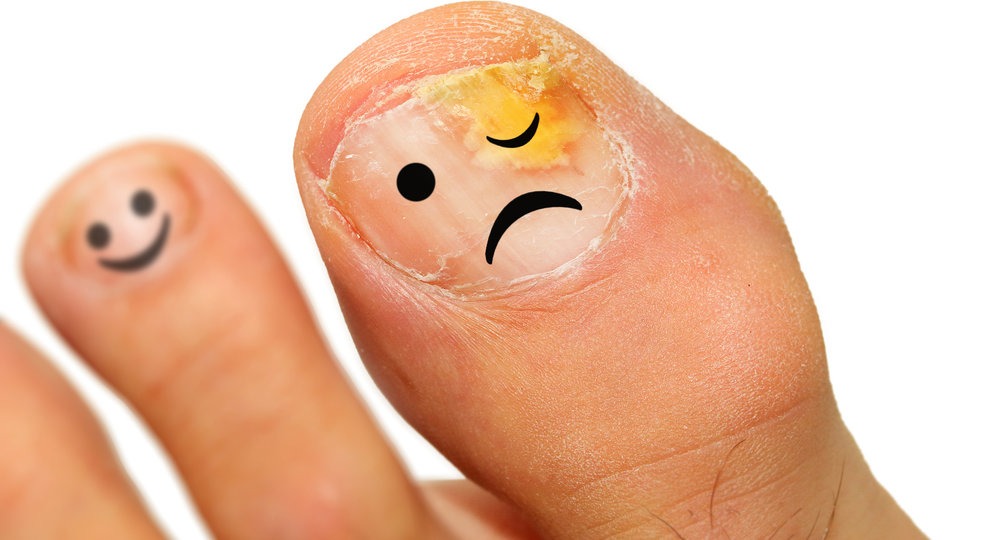 Why Is Toenail Fungus So Difficult to Treat? 4 Why Is Toenail Fungus So Difficult to Treat?