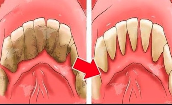 plaque and tartar on teeth
