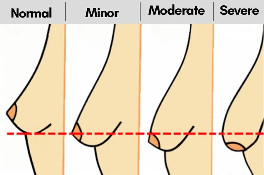 Sagging Breasts: Causes, Early Signs, and Why It Happens at a Young Age 3 check breast sagging