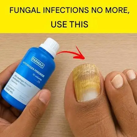 hydrogen peroxide for toenail fungus