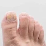 close up foot of nail fungus
