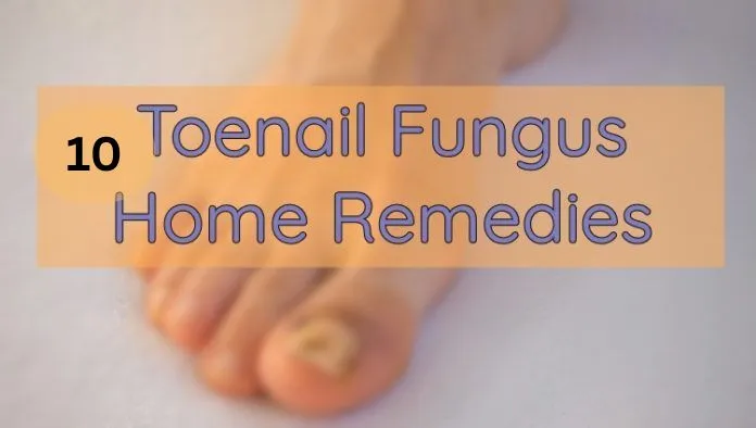 10 Best Home Remedies for Toenail Fungus That Actually Work 1 toenail fungus featured
