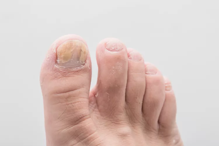 close up foot of nail fungus